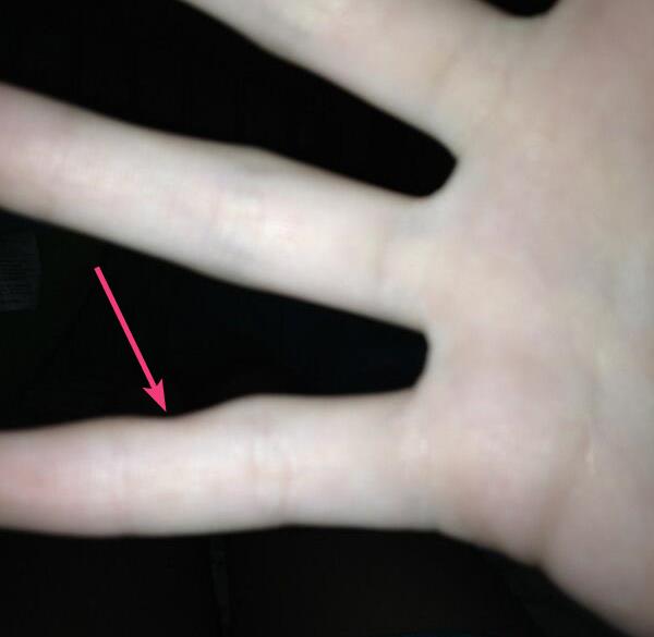 physical deformation due to Smartphone Pinky 